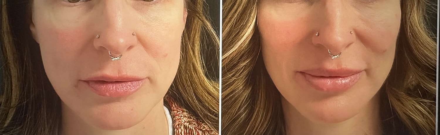 Neurotoxin Before & After