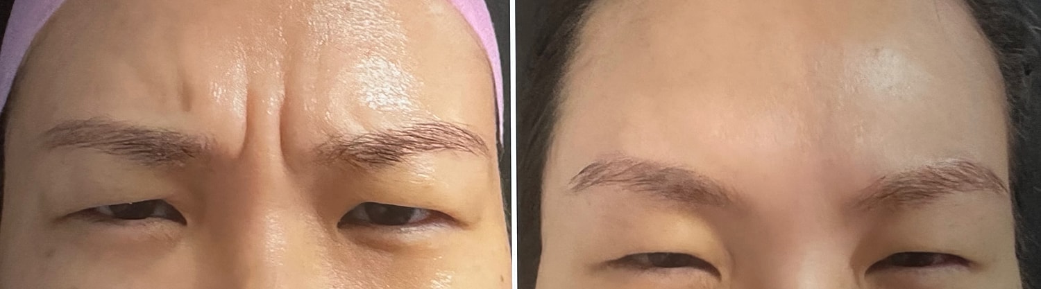 Neurotoxin Before & After