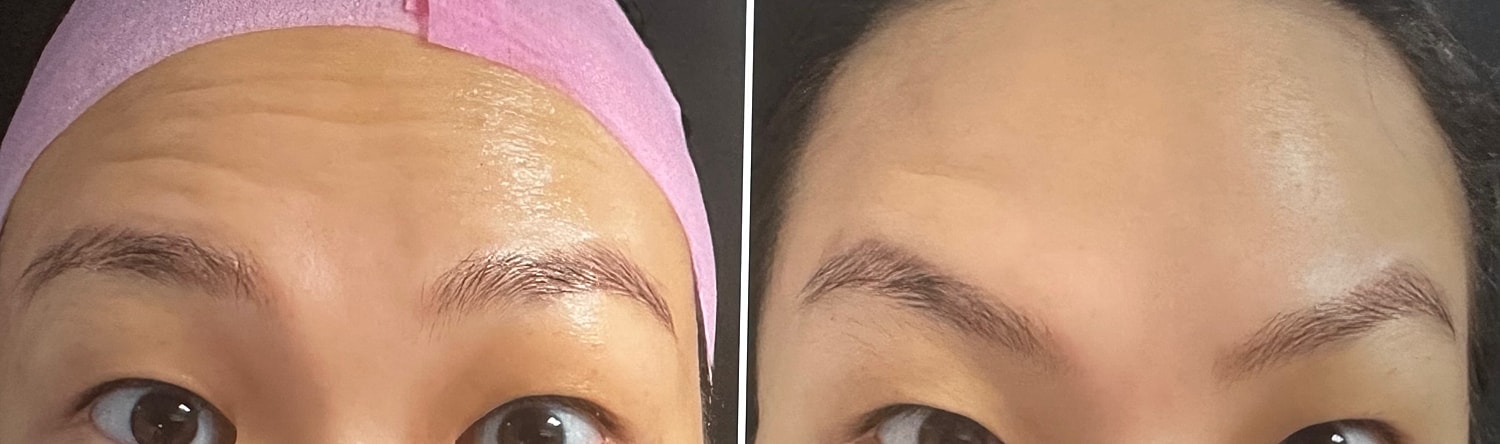 Neurotoxin Before & After