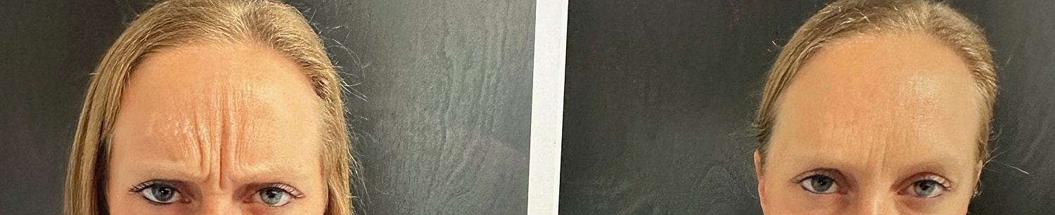 Neurotoxin Before & After