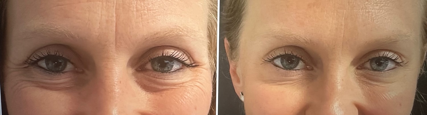 Neurotoxin Before & After