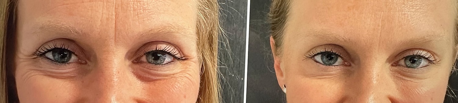 Neurotoxin Before & After