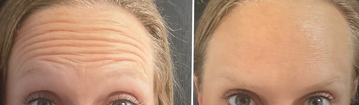 Neurotoxin Before & After