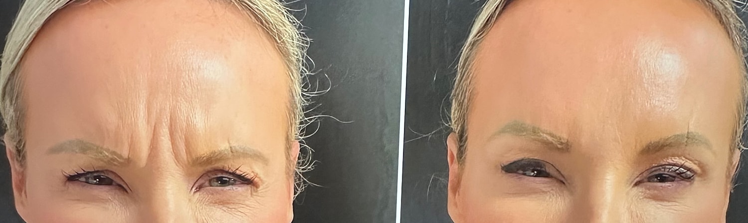Neurotoxin Before & After