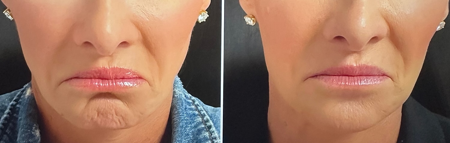 Neurotoxin Before & After