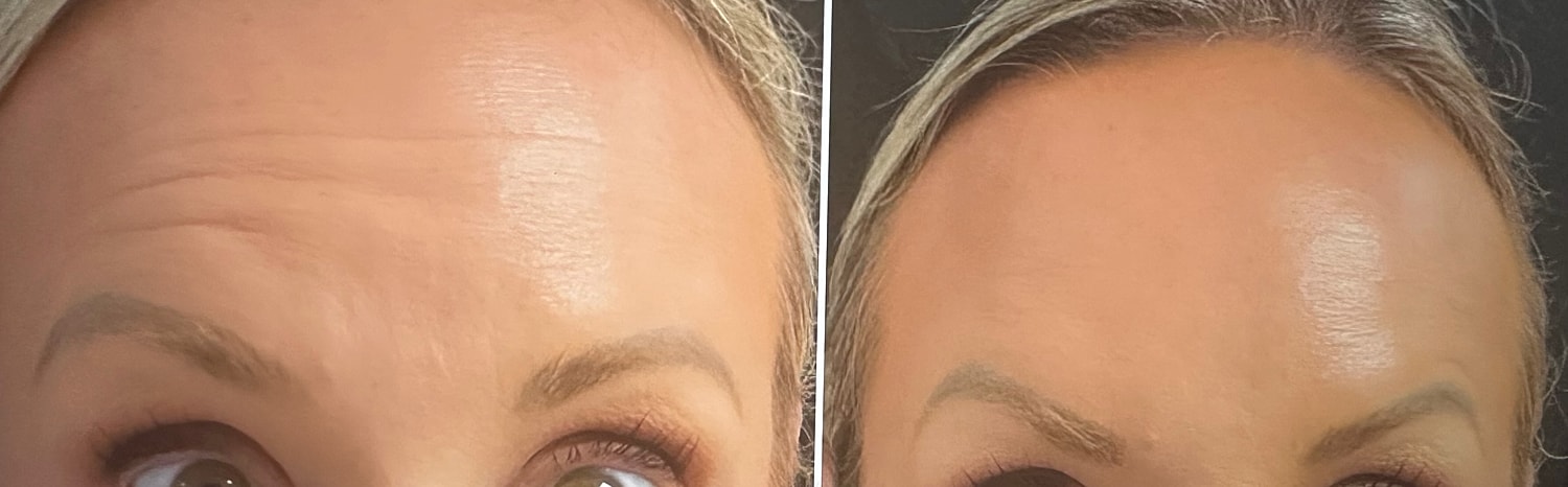 Neurotoxin Before & After