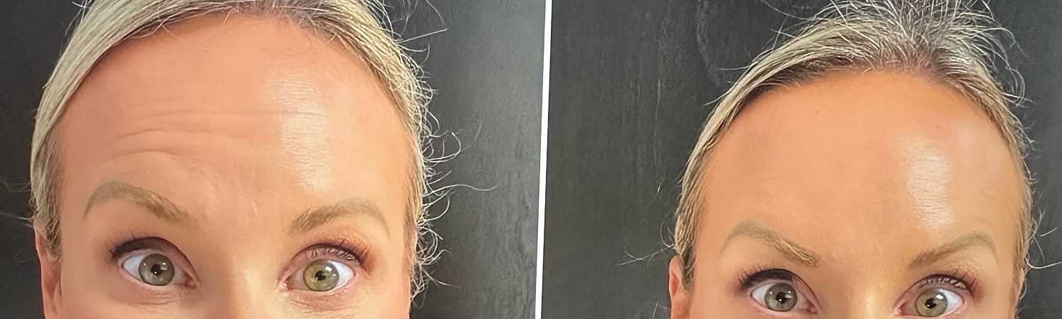 Neurotoxin Before & After