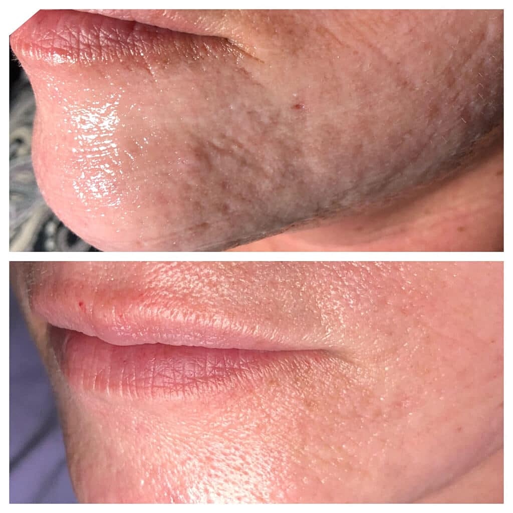 Before & After Image of Acne Scars Columbia MD