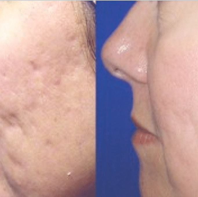Before & After Image of Acne Scars Howard County MD