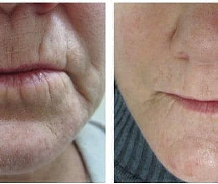 Before & After Image of Anti-Aging Treatment Columbia MD