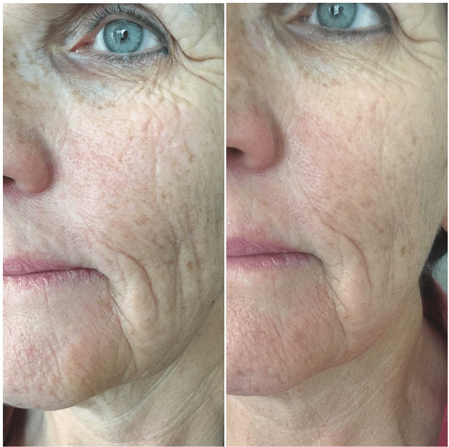 Before & After Image of Anti-Aging Treatment Howard County MD