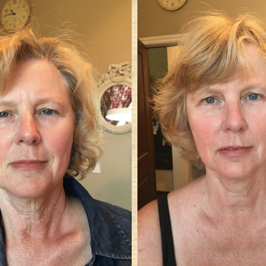 Before & After Image of Microchanneling Howard County MD