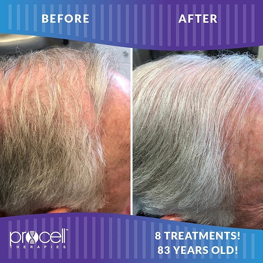 Before & After Hair Restoration Columbia MD