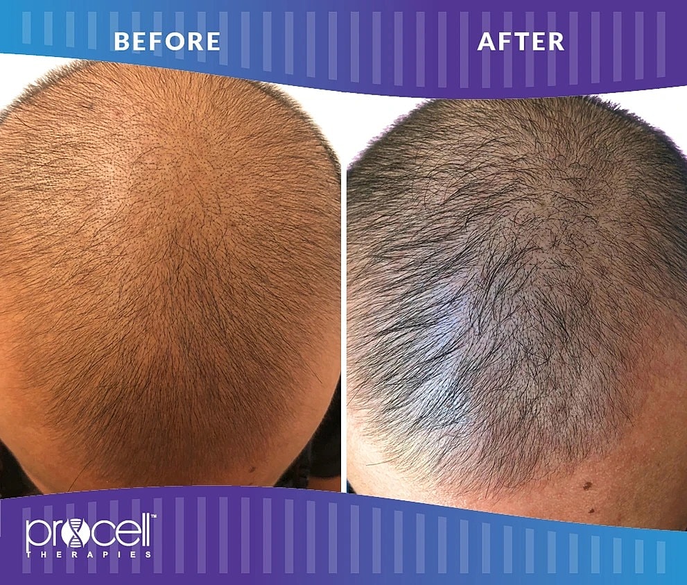 Before & After Hair Restoration Treatment Columbia MD