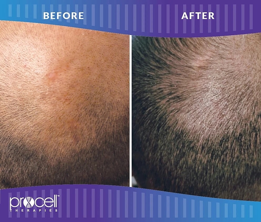 Before & After Hair Restoration Howard County MD