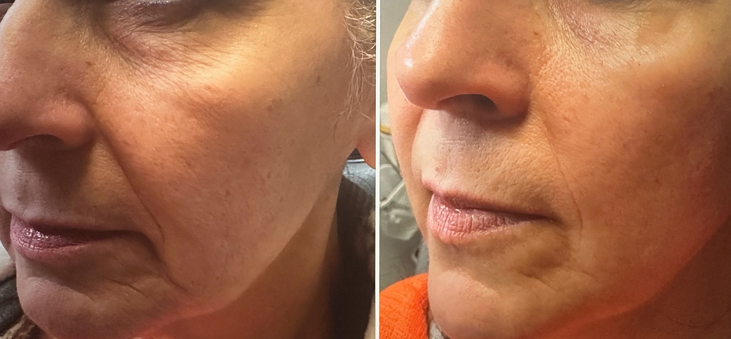 Microneedling Before & After