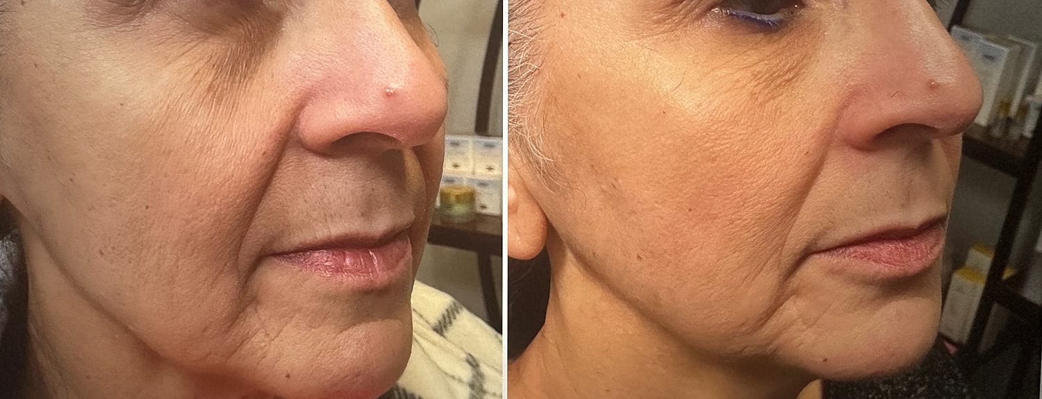 Microneedling Before & After