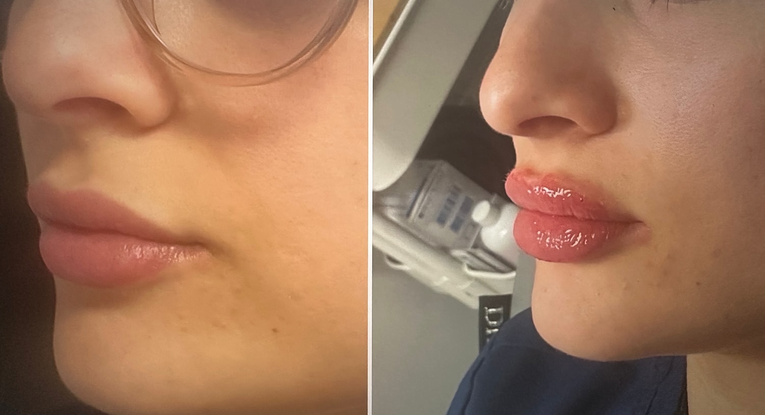 Lip Fillers Before & After