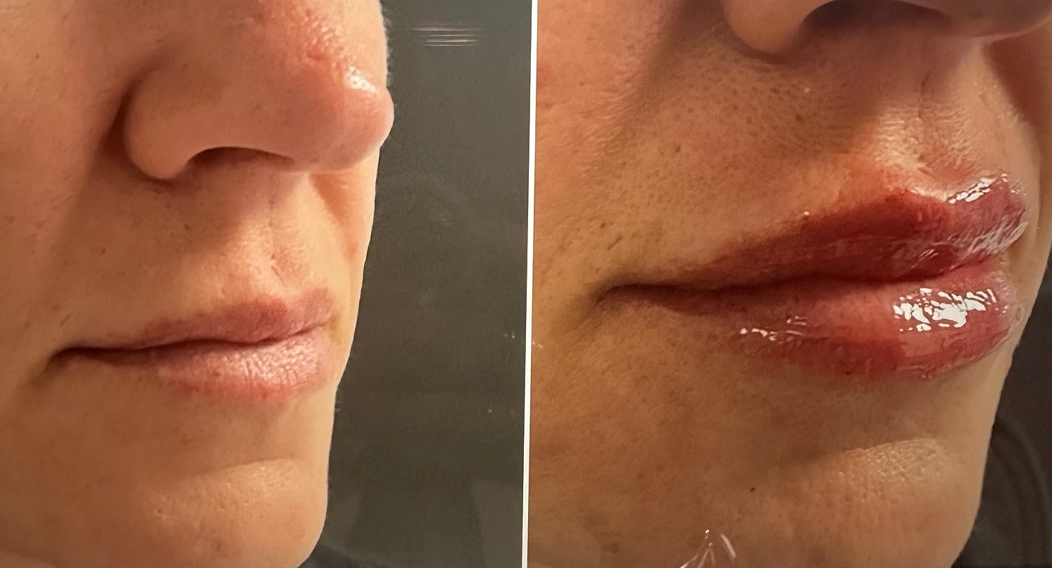 Lip Fillers Before & After