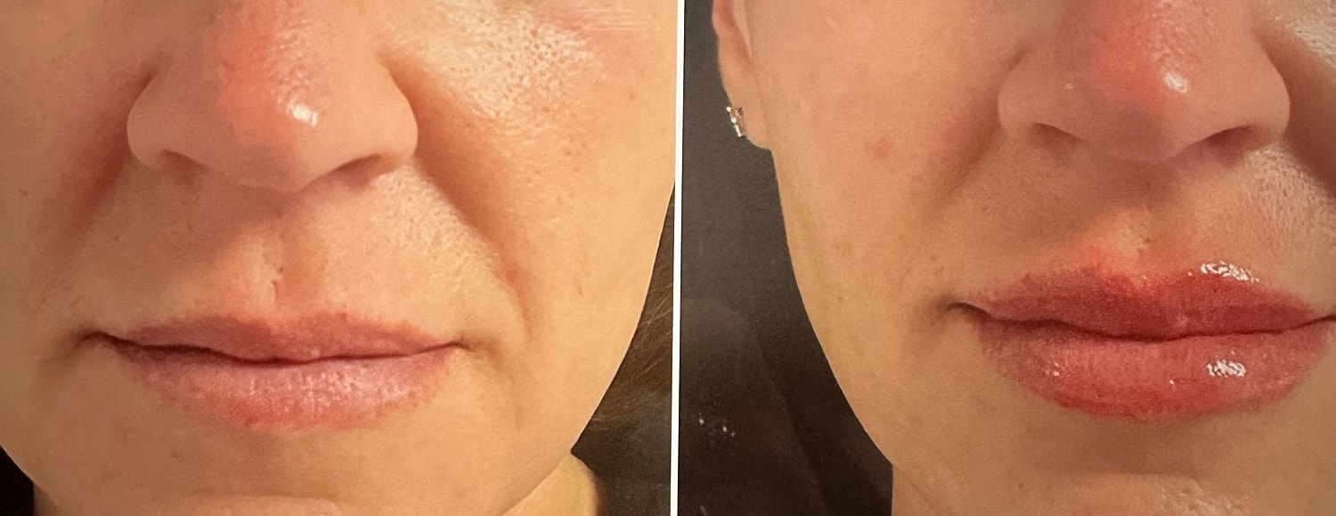 Lip Fillers Before & After