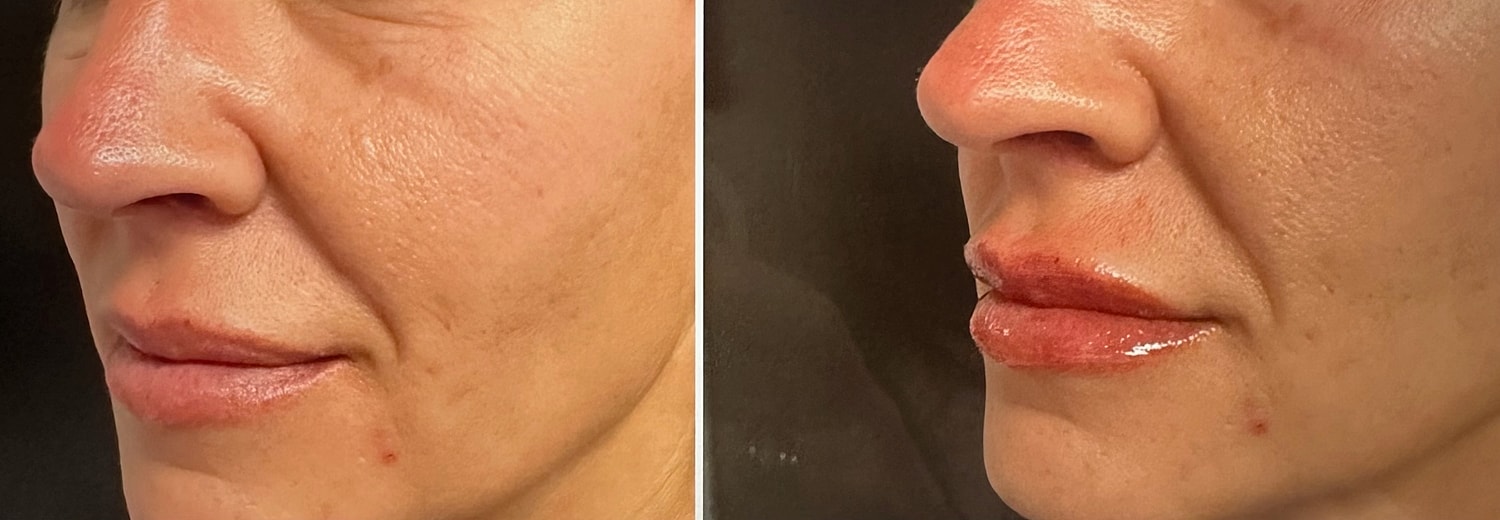 Lip Fillers Before & After