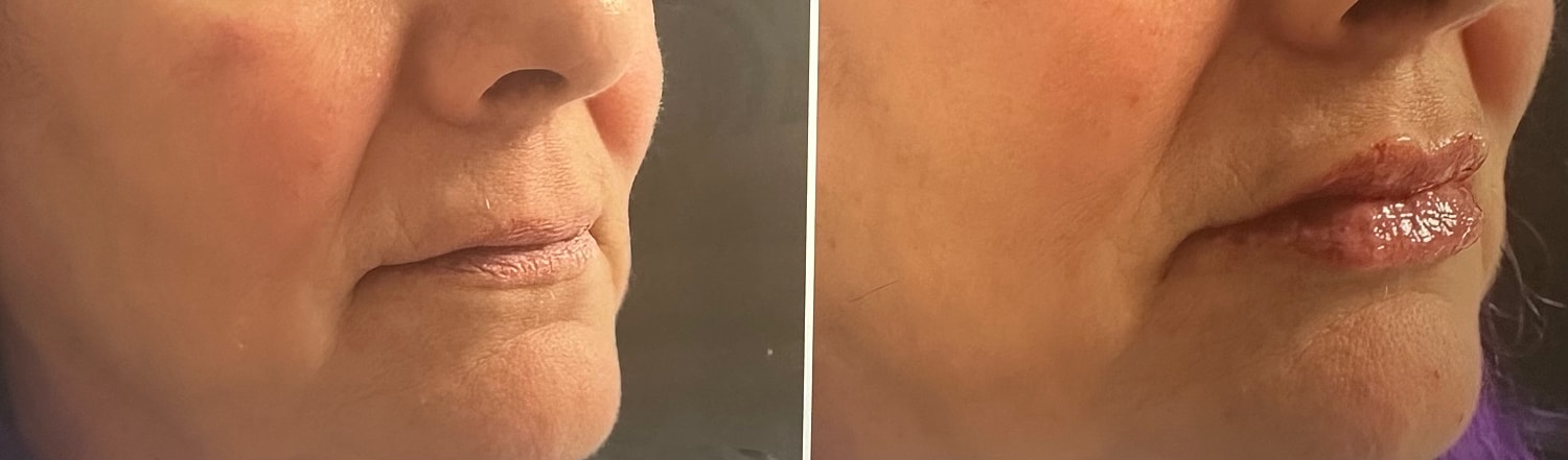Lip Fillers Before & After