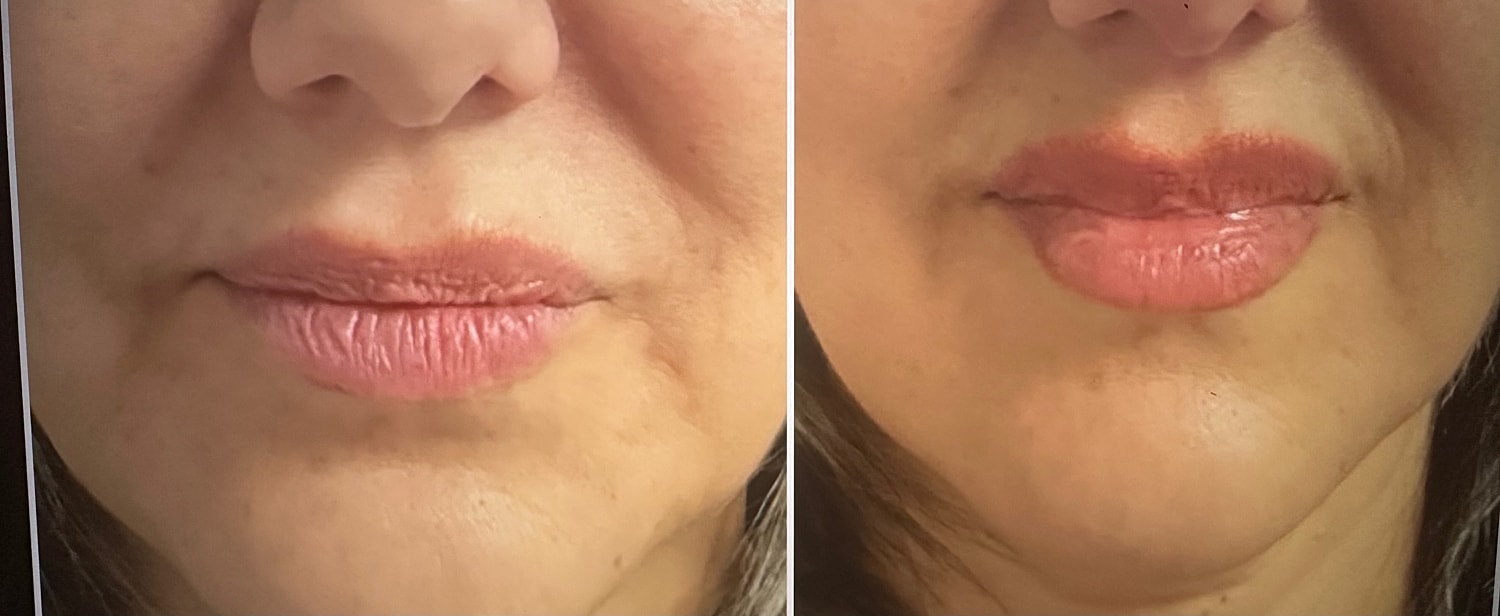 Lip Fillers Before & After