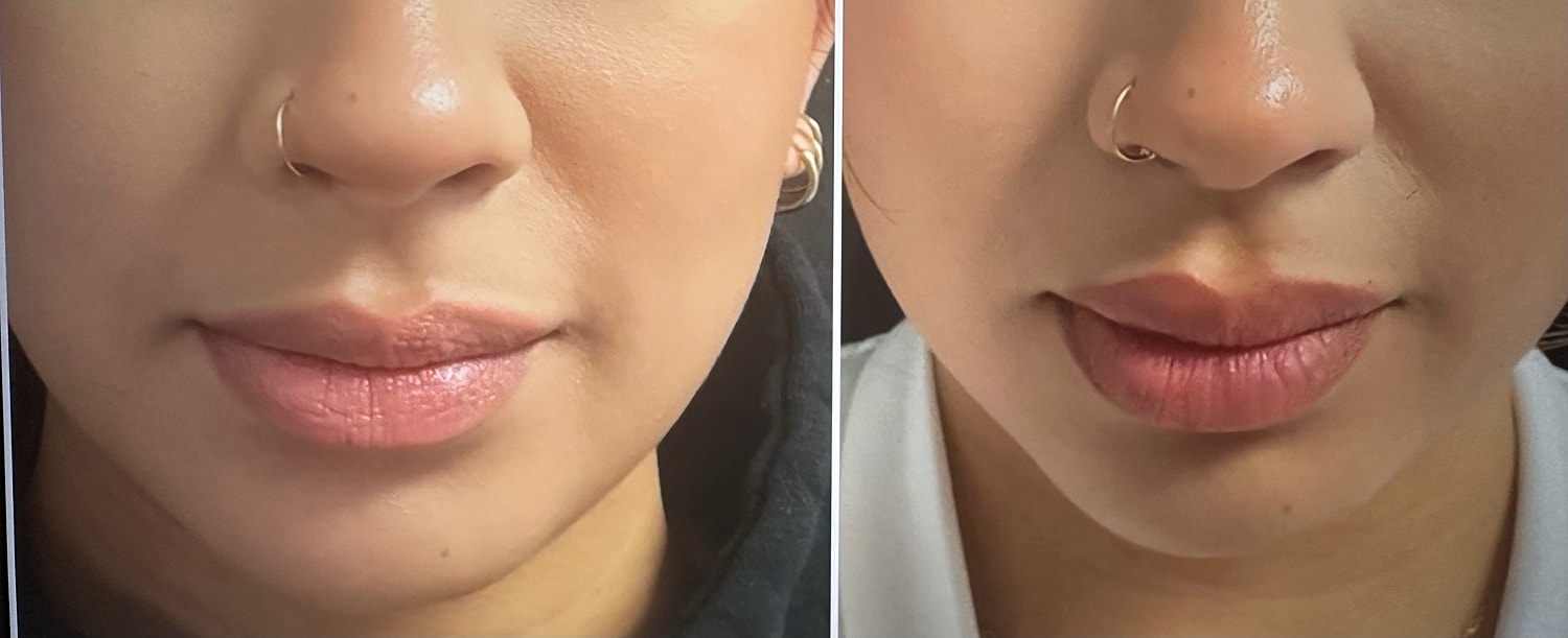 Lip Fillers Before & After