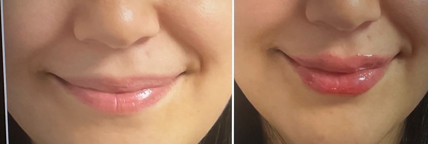 Lip Fillers Before & After