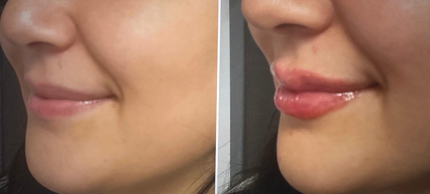 Lip Fillers Before & After