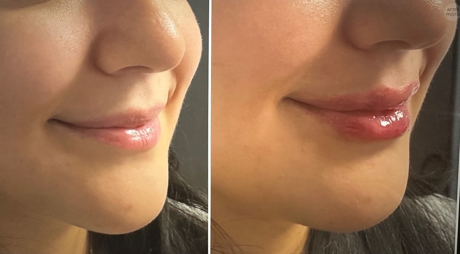 Lip Fillers Before & After
