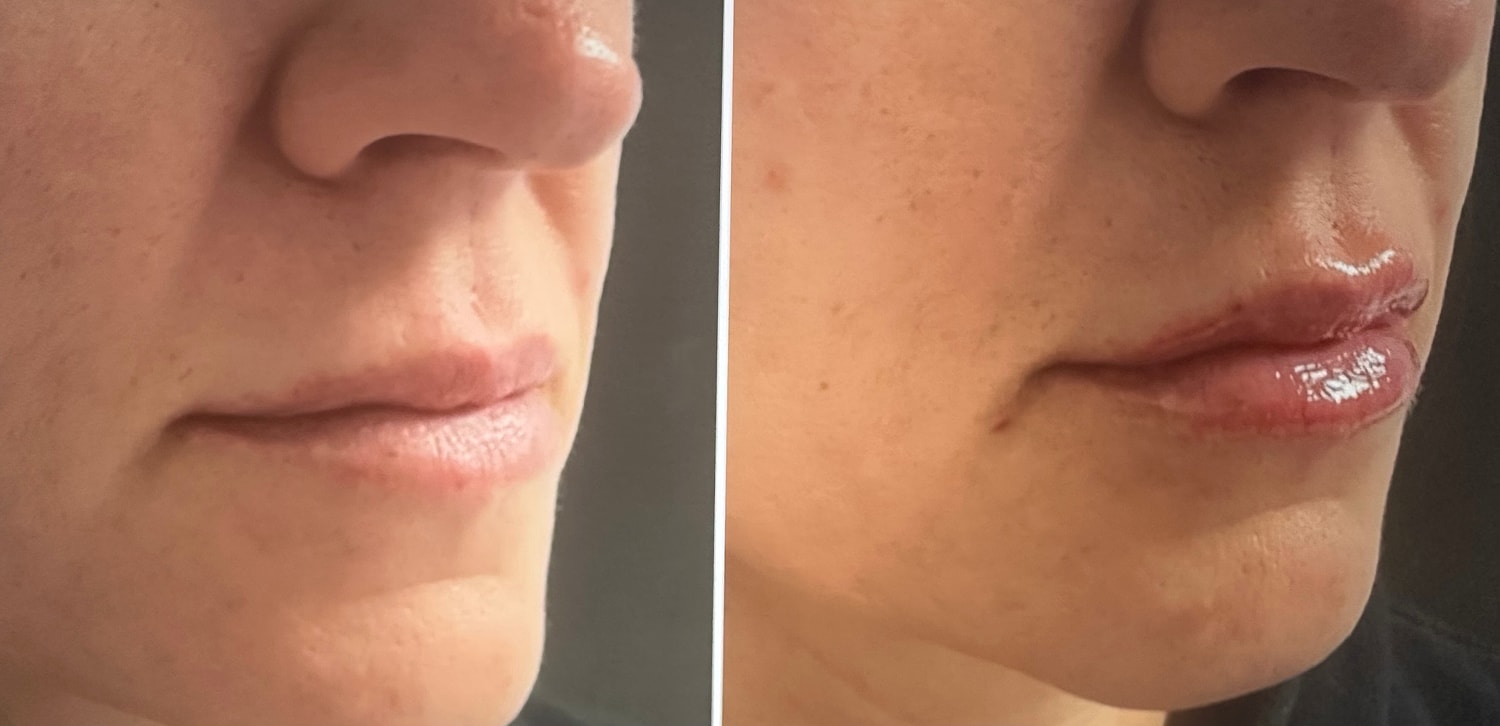Lip Fillers Before & After