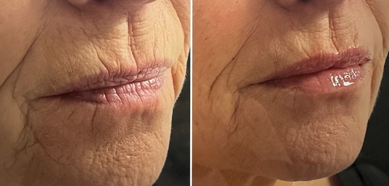 Lip Fillers Before & After