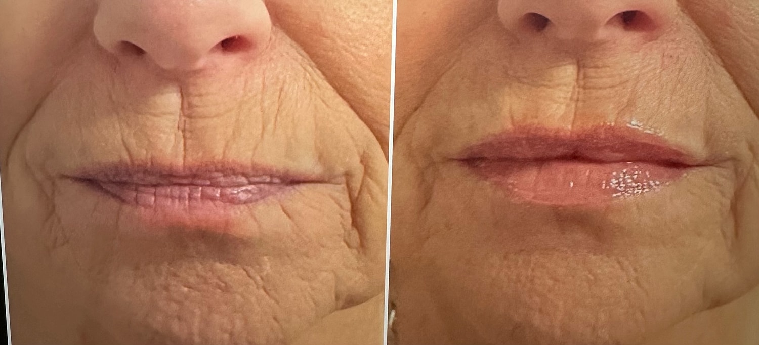 Lip Fillers Before & After