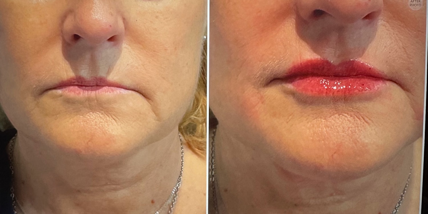 Lip Fillers Before & After