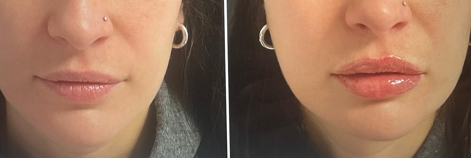 Lip Fillers Before & After