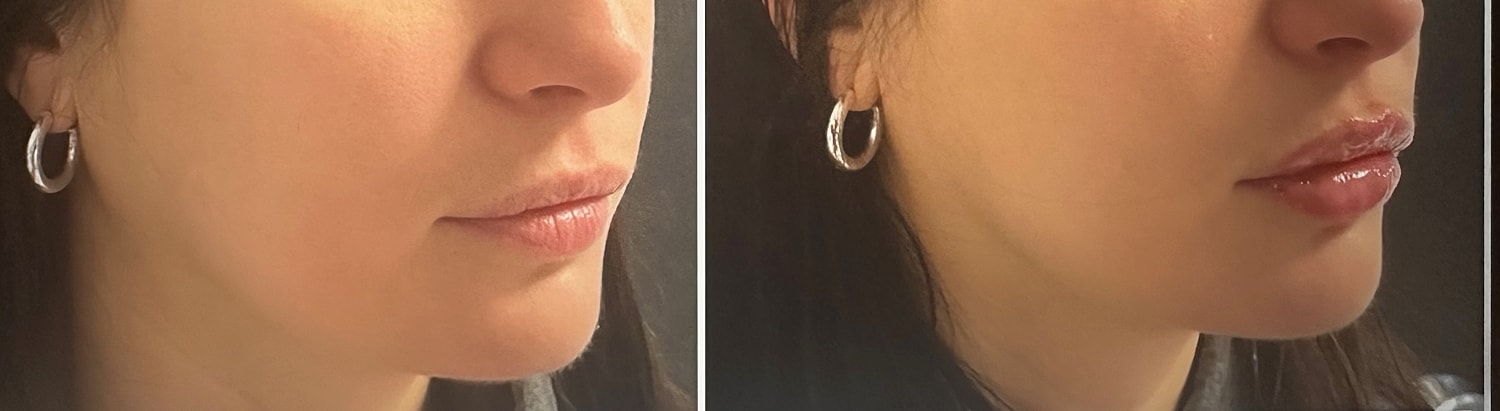 Lip Fillers Before & After