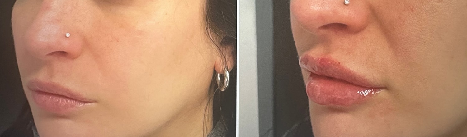 Lip Fillers Before & After