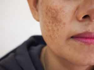 Close up of a woman's face who is suffering from hyperpigmentation, in need of a Cosmelan peel treatment.