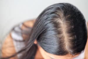 Woman bends forward, showing her scalp to reveal significant hair thinning, before her Procell™ microchanneling treatment